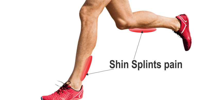 Runners Shin Splints